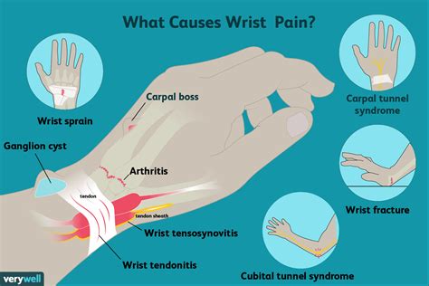wrist pain  symptoms  treatment verywell health hiswai