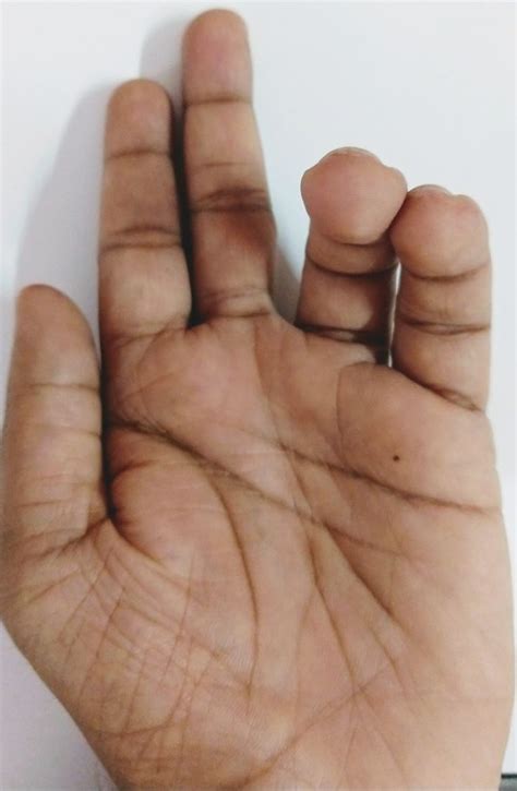 ulnar claw hand  ulnar paradox medicocyte   ulnar nerve hand surgery median nerve