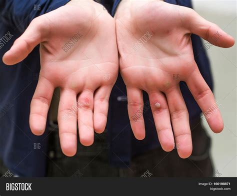male hands palms painful unhealthy image photo bigstock