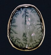 Bildergebnis für Neurocysticercose. Größe: 171 x 185. Quelle: www.medicalnewstoday.com
