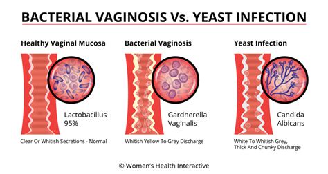 Bacterial Vaginosis Causes Symptoms And Treatment Nursa