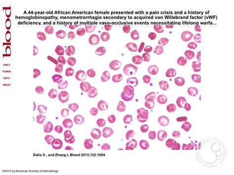 homozygous hemoglobin  disease