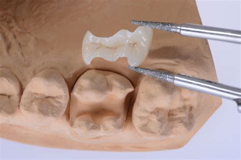 dental inlays  onlays phoenix az choules family dentistry