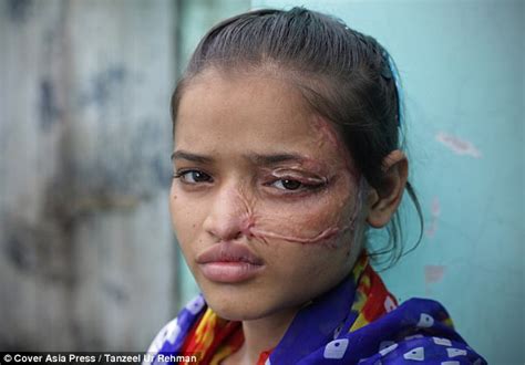 indian acid attack victim shares results of surgery daily mail online
