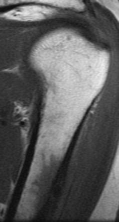 calcific tendinitis   pectoralis major insertion image