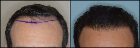 Losing Your Hairline Achieving The Most Natural Results In Hair