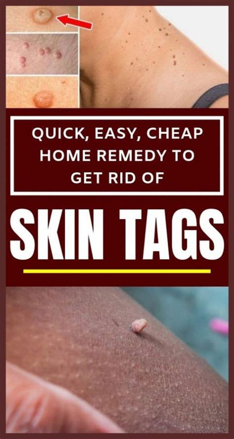 quick easy cheap home remedy to get rid of skin tags in 2020 skin