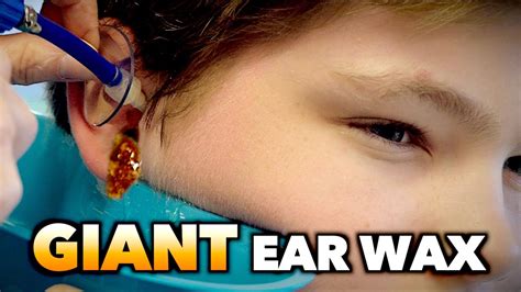 giant ear wax removal dr paul youtube