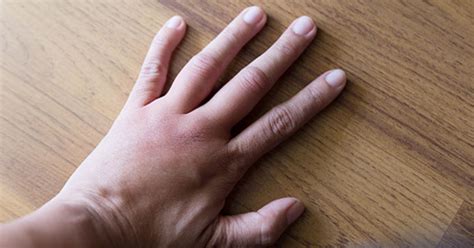 swollen knuckles    reduce swelling