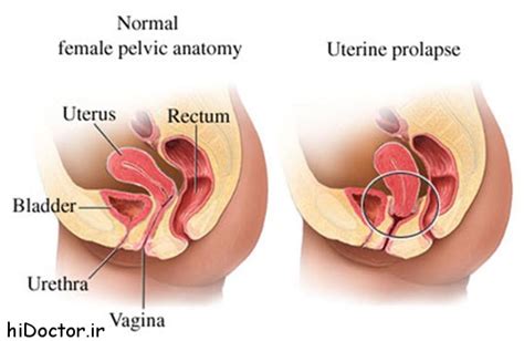 uterine prolapse مجله پزشکی دکتر سلام سلامت زیبایی