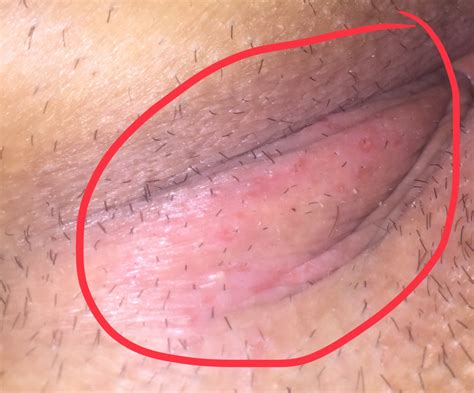 Is This Herpes Or A Yeast Infection Please Help I Am Scared 😟