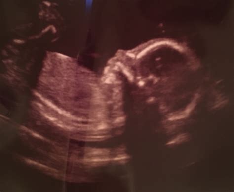 20 weeks anatomy ultrasound 😍 glow community