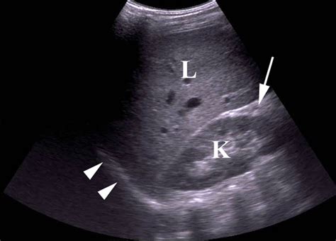 kidney ultrasound march