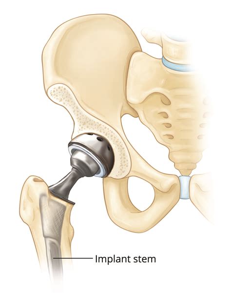 fracture  total hip replacement orthopedic sports medicine