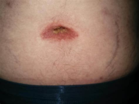 Belly Button Candidiasis All You May Need To Understand