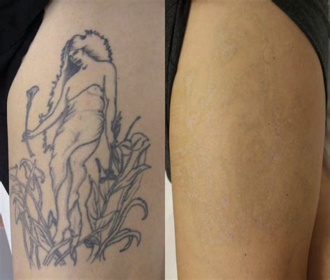 natural tattoo removal dermabrasion tattoo removal  fact