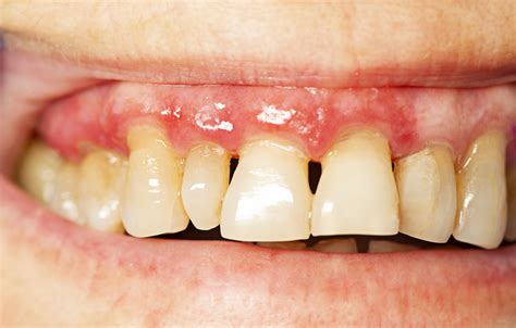 gum disease beverly hills ca dental group  beverly hills