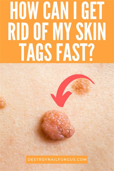 what are the best ways to treat skin tags naturally the top 5 remedies