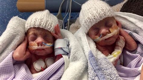 miracle twins born   weeks beat  odds  survive