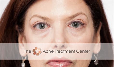 acne treatment center botox treatment acne treatment