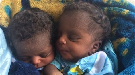 conjoined twins survive gruelling journey to separation robbies world blog