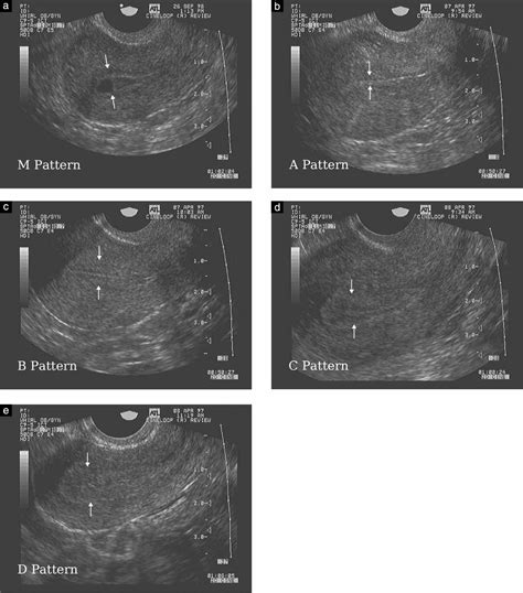 Endometrial Development In Association With Ovarian Follicular Waves