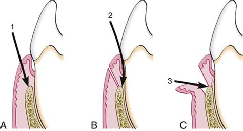 periodontal flap pocket dentistry