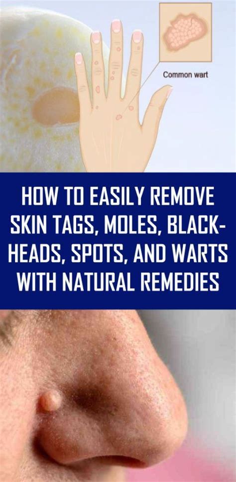 how to easily remove skin tags moles blackheads spots