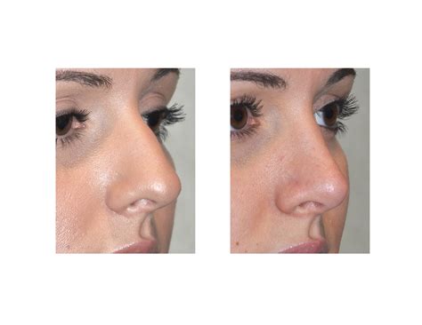 case study rhinoplasty   greek nose explore plastic surgery