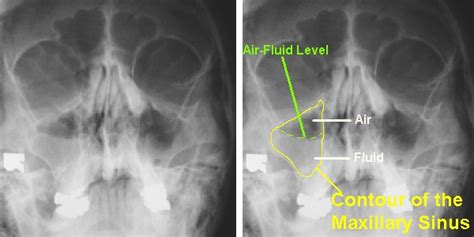 캐비닛 Postnasal Drip Syndrome I Sinusitis Imaging