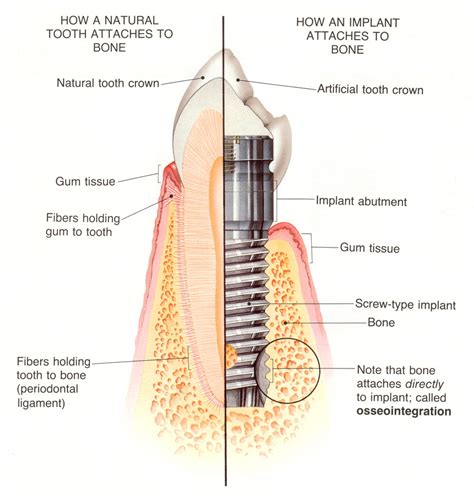 dental implants london