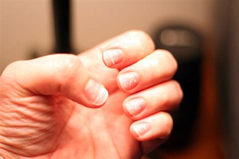 Nail Issues And Fungal Toe Care Tips Pre Tend Be Curious