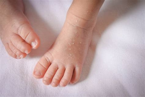 kulit kering  bayi penyebab  mengatasi