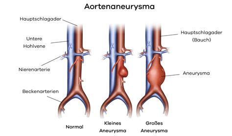ist ein aortenaneurysma hypersioncom
