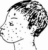 Measles Drawing Getdrawings sketch template