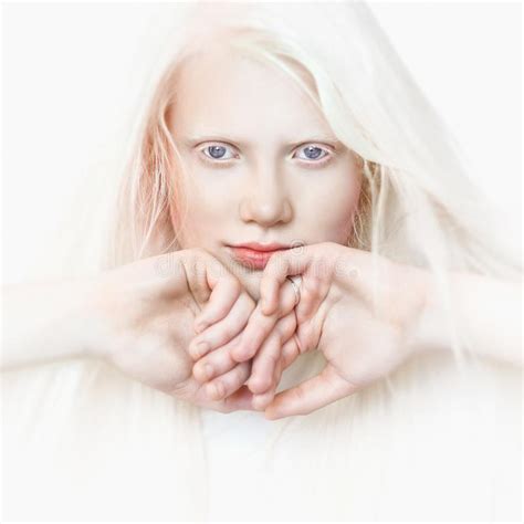 Albino Girl With White Pure Skin Blue Eyes And White Hair