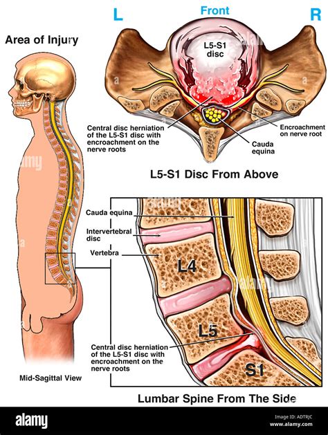 massive   lumbar disc herniation  nerve root impingement stock photo  alamy