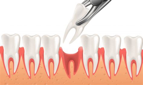 overview  tooth extraction procedure