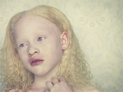 Albinism Genetic Disorders