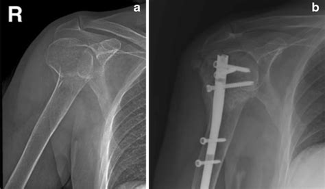 treatment of two part proximal humerus fractures intramedullary nail