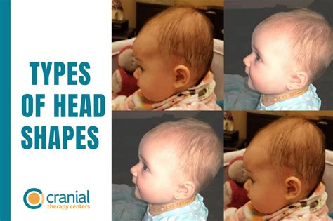 babies head shapes  consequences cranial therapy centers