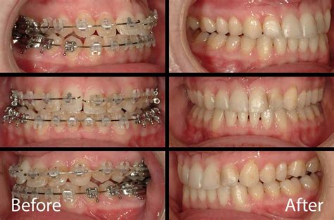 Face Airway And Bite Correction Surgery Solution Corrective Jaw