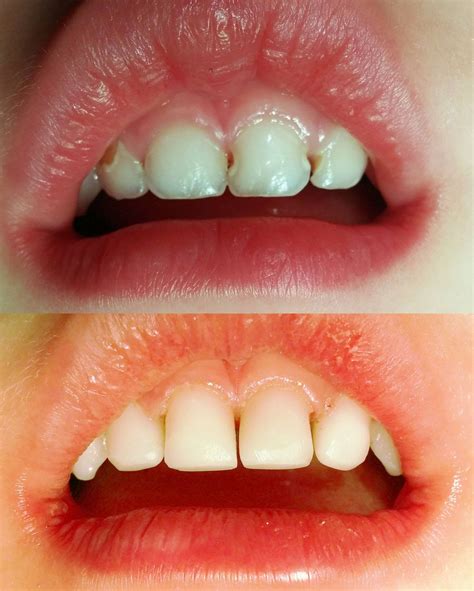 Staining Or Cavities On The Front Teeth Playtime
