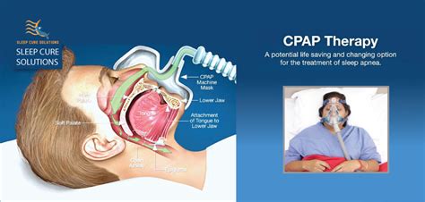 cpap aviss health
