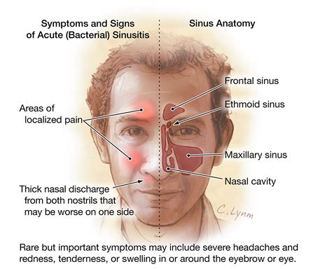 adult sinusitis otolaryngology jama jama network