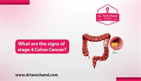Does Colon Cancer Spread Fast In 2022