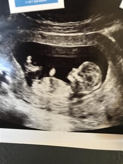 skull theory or nub guesses 12 week ultrasound twins in ultrasound