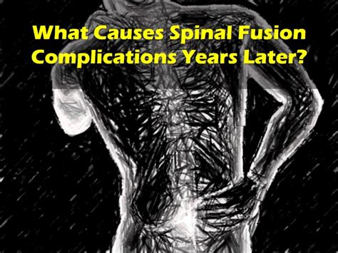 Lumbar Fusion For Spinal Fusion Complications Years Later