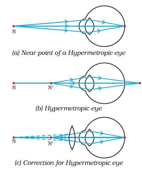 astigmatism measurements explained hypnotherapy to lose