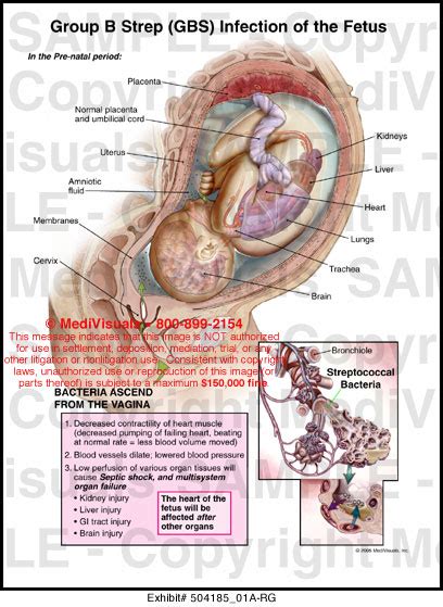 Group B Strep Gbs Infection Of The Fetus Medical Exhibit